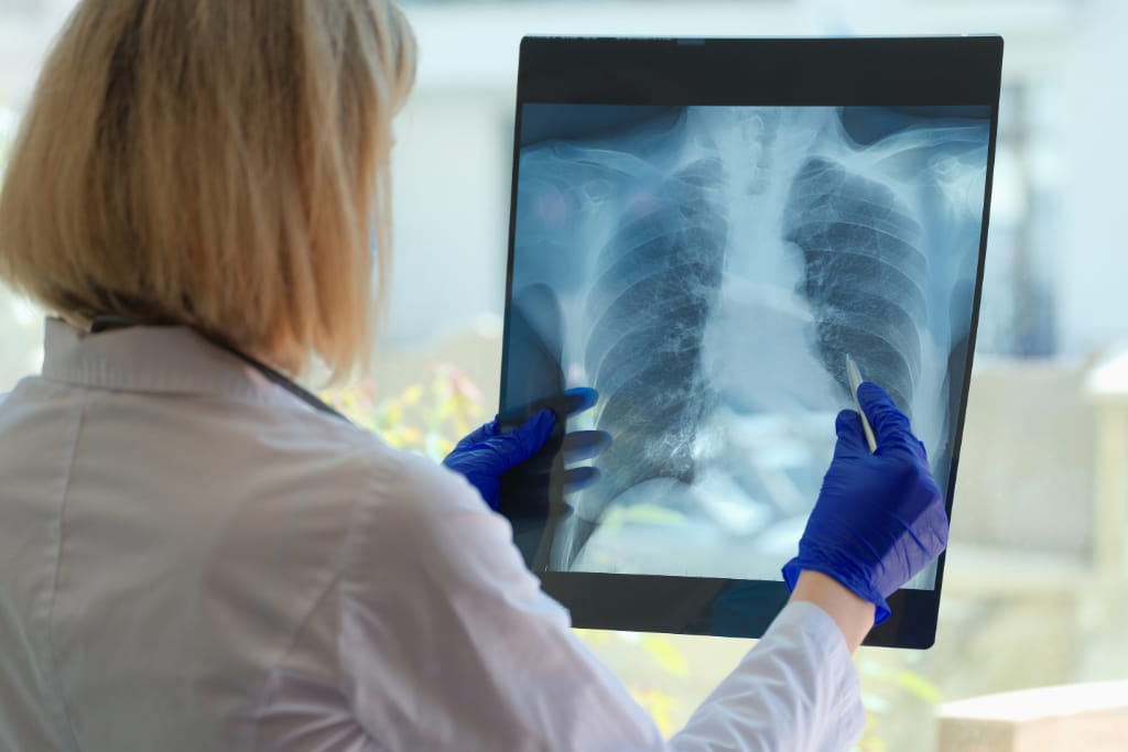 Lung cancer